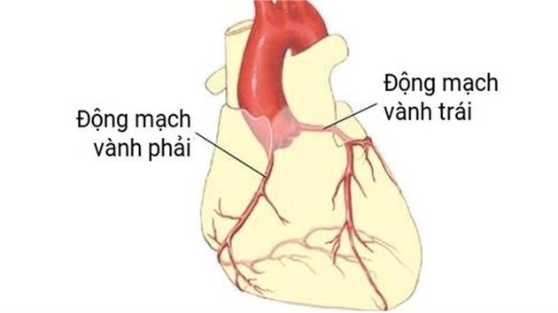 Bác sĩ phân tích cơ chế và cách chuẩn đoán bệnh mạch vành cấp 