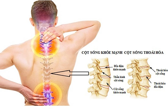 Nguyên nhân và cách khắc phục thoái hóa cột sống 