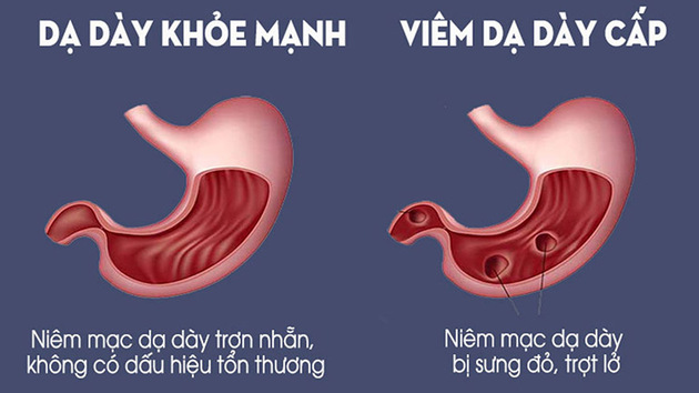 Dược tuệ tĩnh chia sẽ các triệu chứng viêm dạ dày nên biết