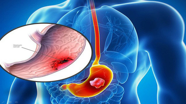 Các thắc mắc thường gặp bệnh nhân khi đi nội soi dạ dày