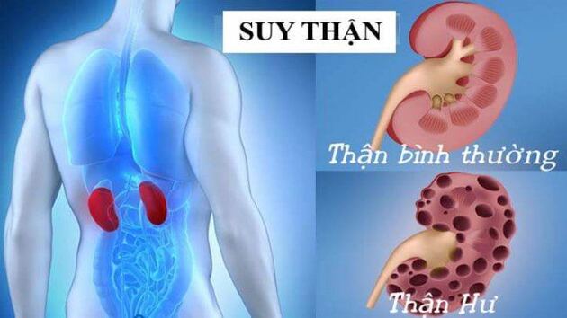 Bác sĩ chia sẽ các dấu hiện bệnh suy thận 