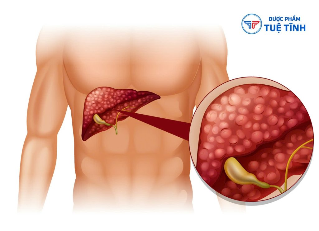 Dược phẩm Tuệ Tĩnh chia sẻ các hiểu biết về gan nhiễm mỡ