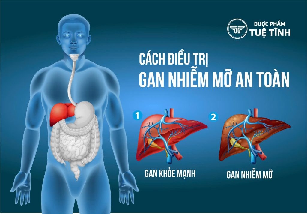 Dược phẩm Tuệ Tĩnh chia sẻ cách điều trị gan nhiễm mỡ an toàn