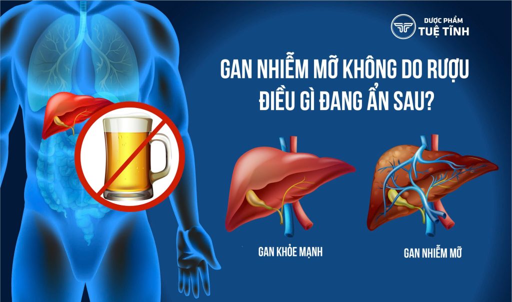 Làm thế nào để nhận biết và điều trị bệnh gan nhiễm mỡ không do rượu? 