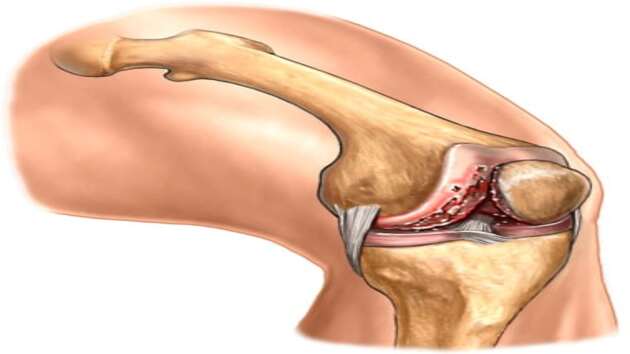 Bệnh thấp khớp – khi nào bạn cần đến gặp bác sĩ?