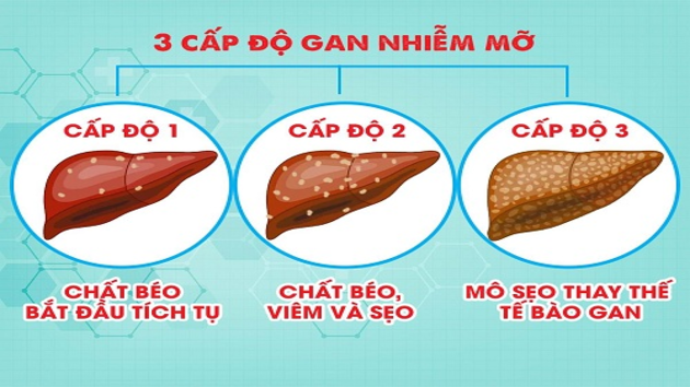 Chữa gan nhiễm mỡ có thực sự hiệu quả không? 