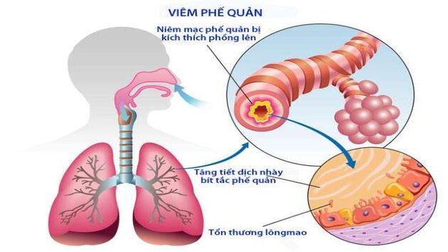 Viêm phế quản những điều cần biết 