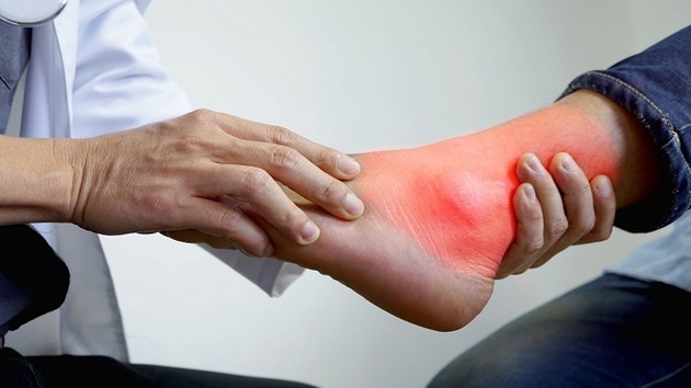 Bệnh gout và một số điều bạn nên biết 